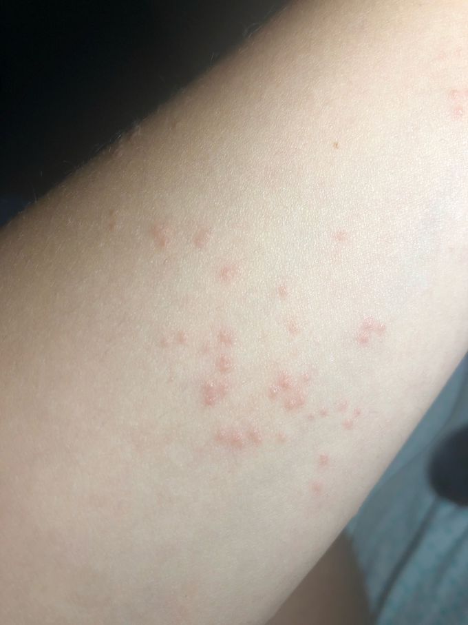 Red point on arm