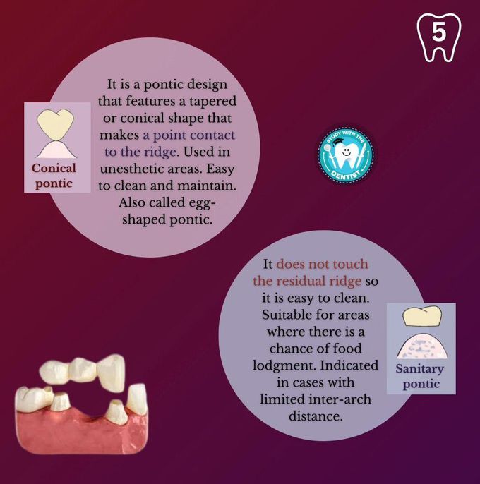 Types of Pontics III