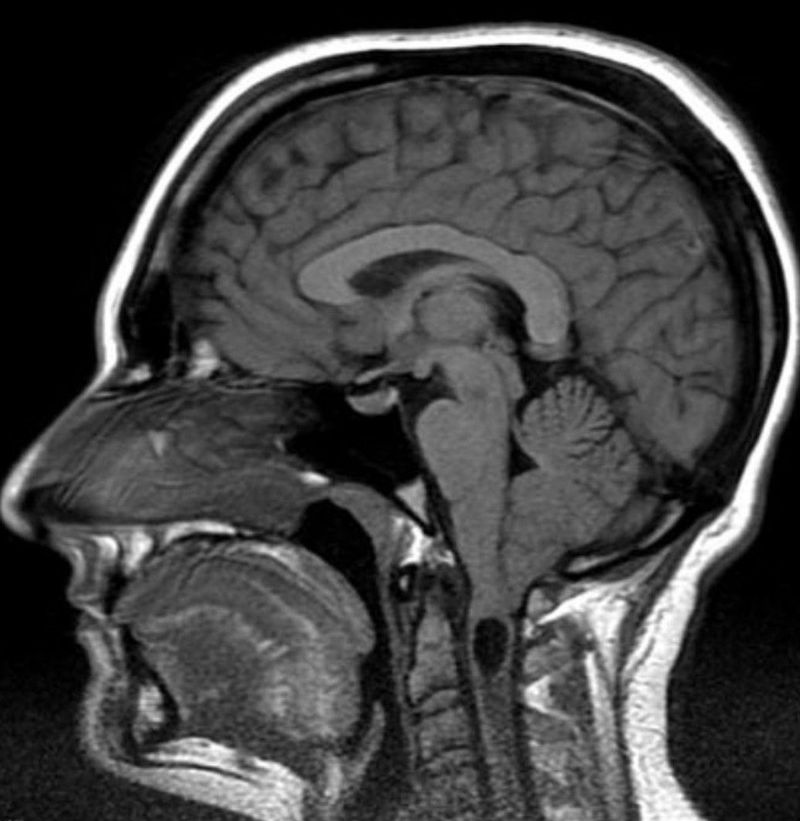 CHIARI 1 MALFORMATIONS - MEDizzy