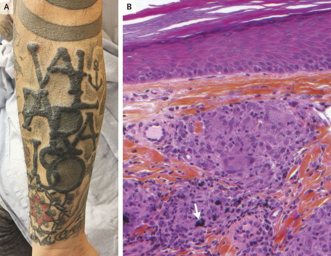 Sarcoidal Reaction in a Tattoo