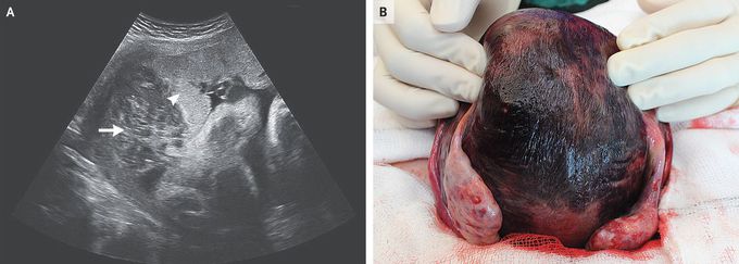 Couvelaire Uterus