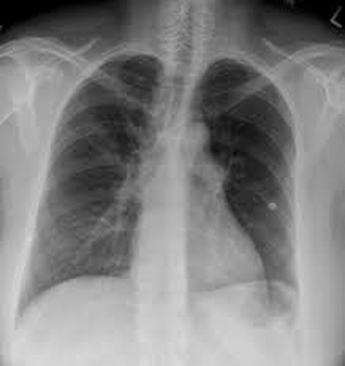 Symptoms of pulmonary embolism