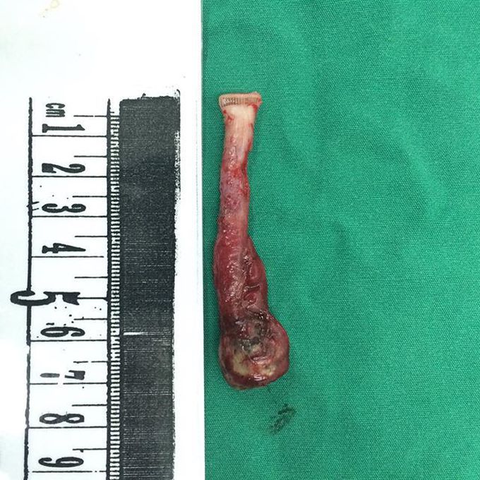 Another McBurney worm
