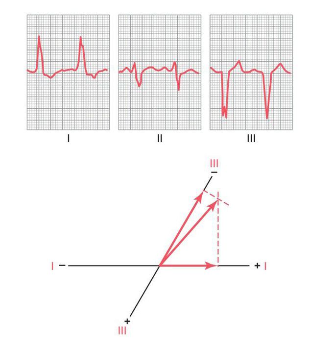 Left bundle branch block