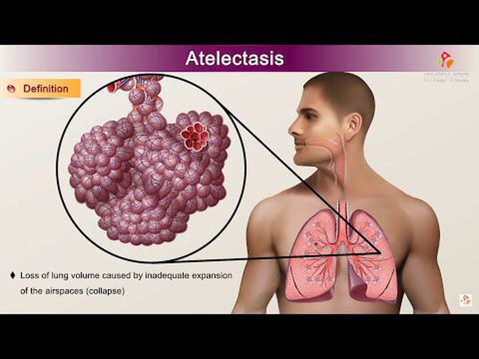 Pathology of Atelectasis