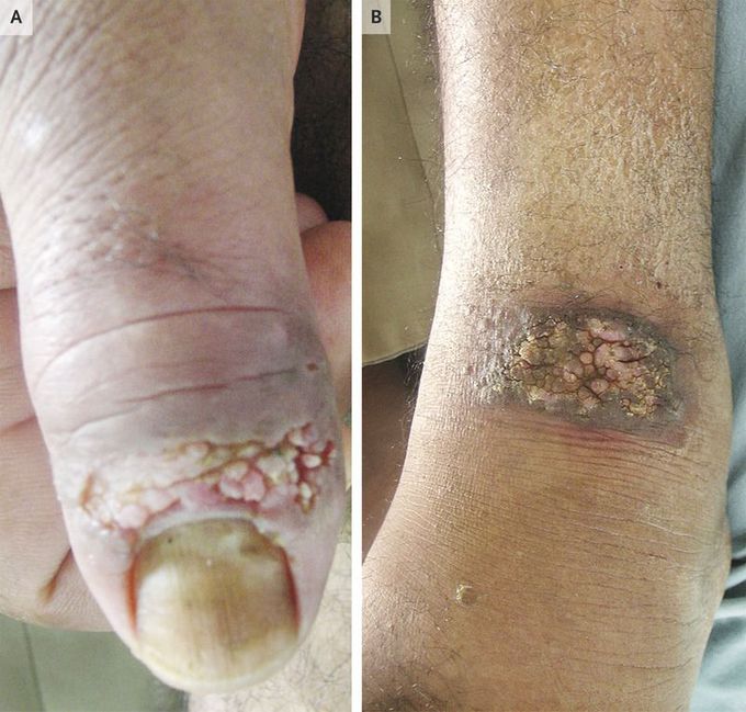 Cutaneous Leishmaniasis with a Paronychia-like Lesion