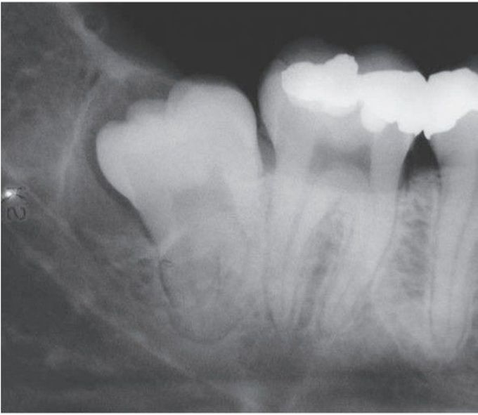 Dentigerous cyst associated with impacted mandibular 3rd molar