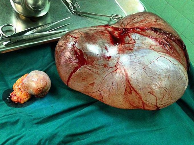 Huge Ovarian Cyst