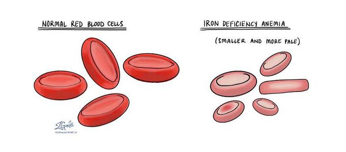 Treatment of iron deficiency anemia