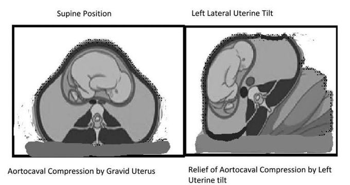 Aortocaval compression