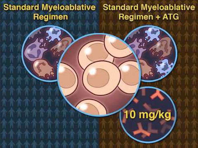 Antilymphocyte Globulin: Overview