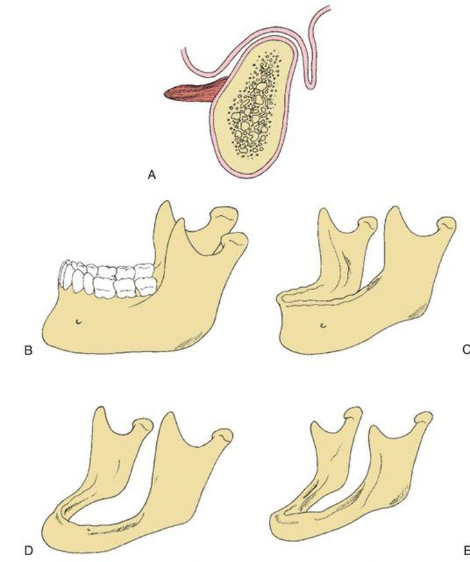 Resorption of alveolar bone