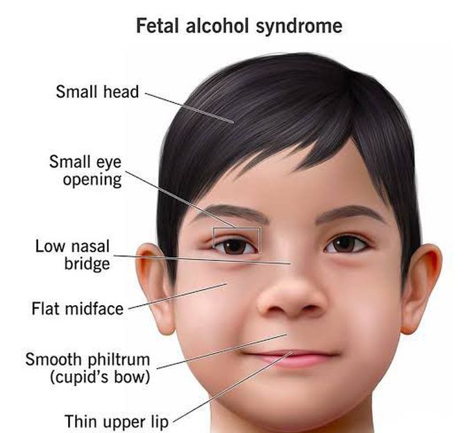 These are the symptoms of Fetal alcohol syndrome