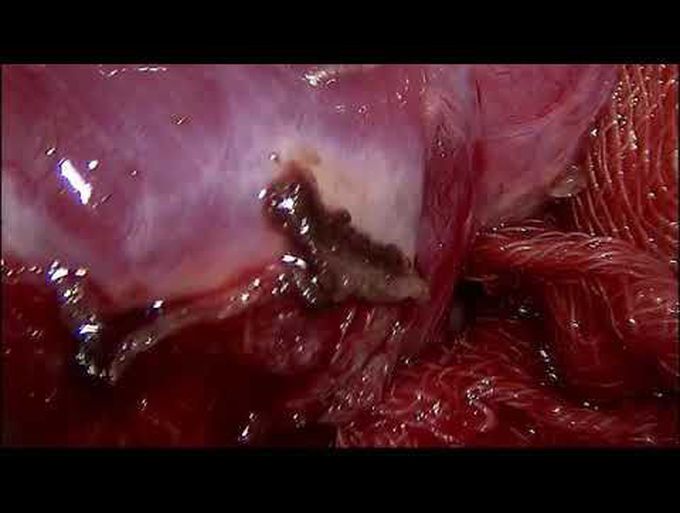 Video-Assisted Thoracoscopic Lobectomy for Giant Congenital Bulla of Left Upper Lobe: A Case Report