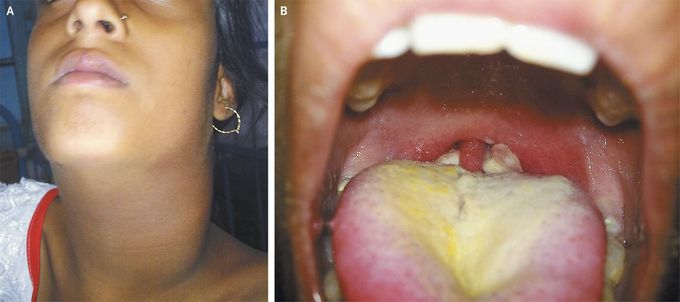 Respiratory Diphtheria