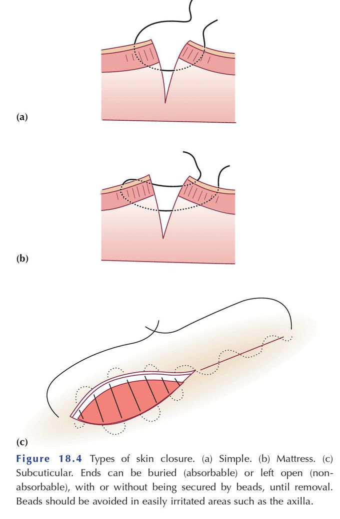Wound skin closures