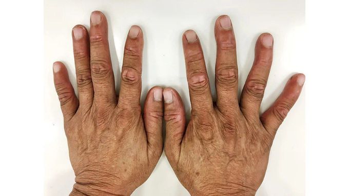 Hand foot syndrome