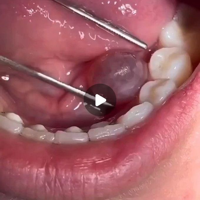 Diagnosis of ranula