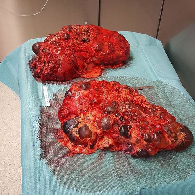 Super massive polycystic kidneys, the left kidney being 5.6kg and the right one 4.9kg!