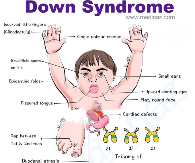 Down syndrome