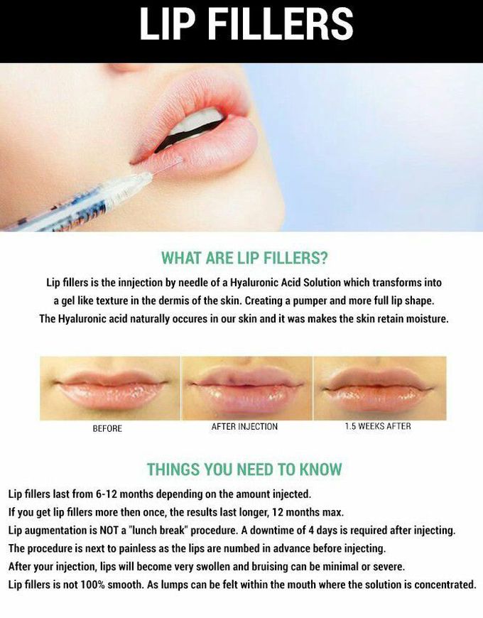 Lip filers