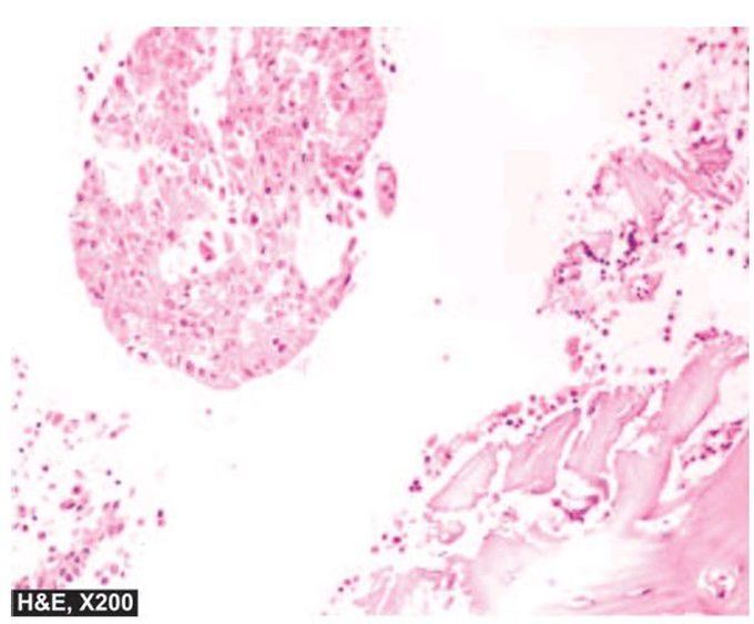 Carcinoma breast