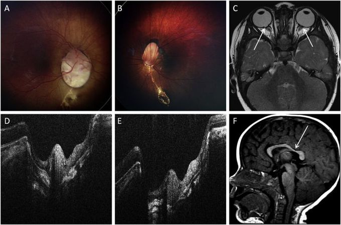 Aicardi Syndrome