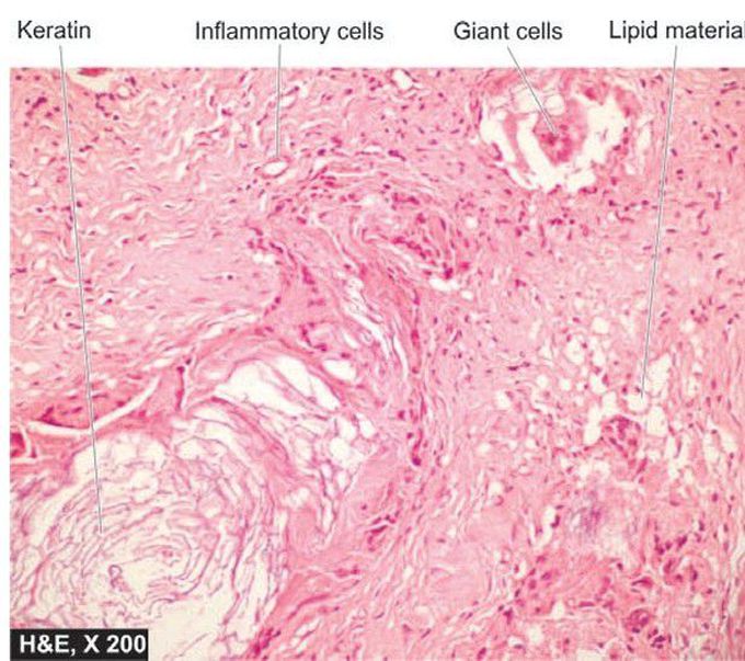 Cholesteatoma middle ear.