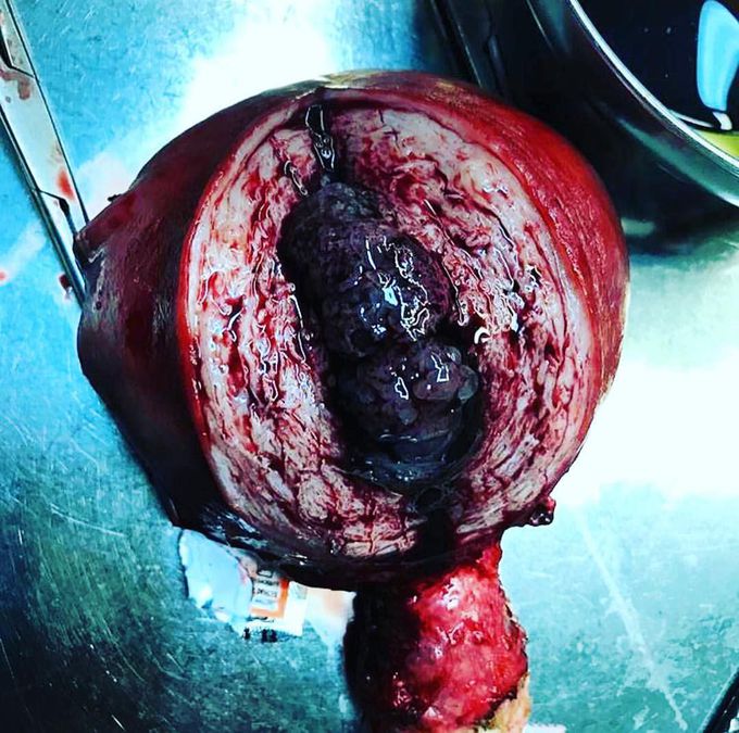 Hysterectomy for a molar pregnancy!