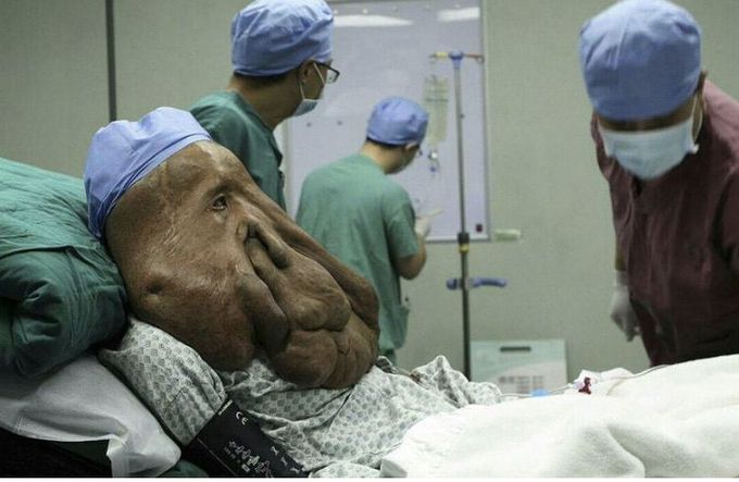 PLEXIFORM NEUROFIBROMA