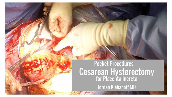 Cesarean Hysterectomy Placenta Accreta