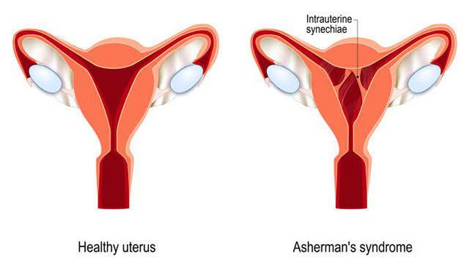 Asherman Syndrome