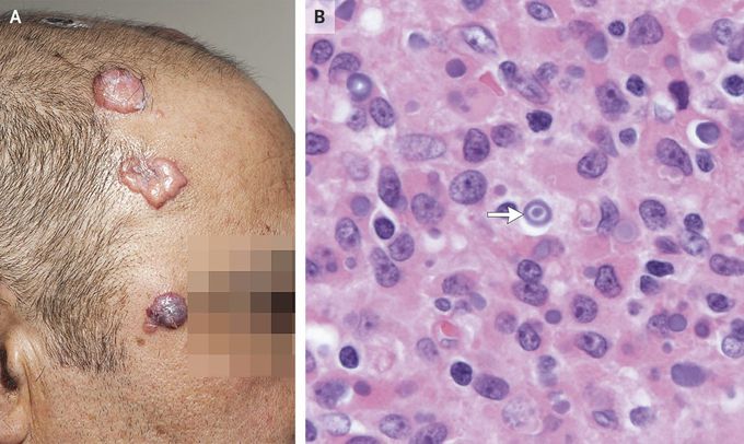 Cutaneous Malakoplakia