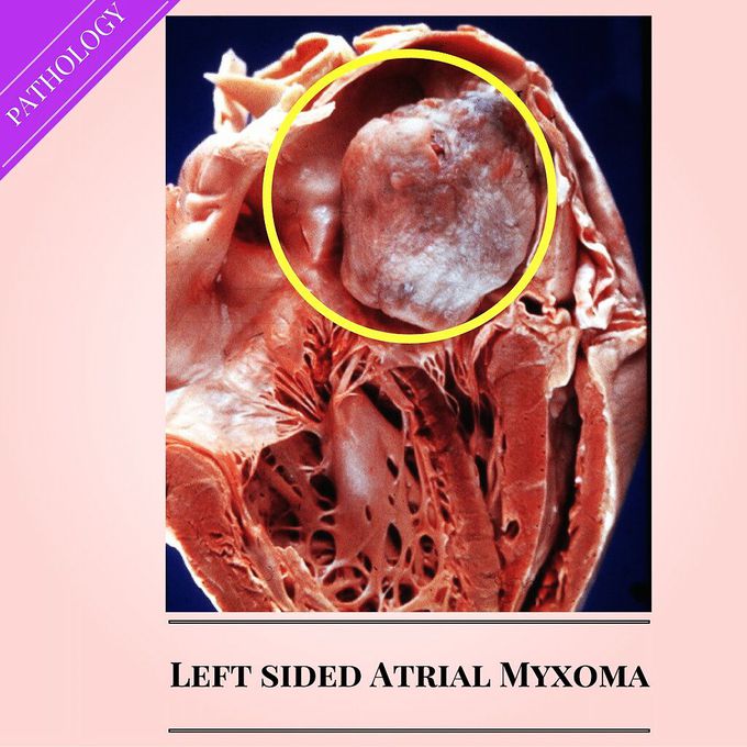 Left Sided Atrial Myxoma