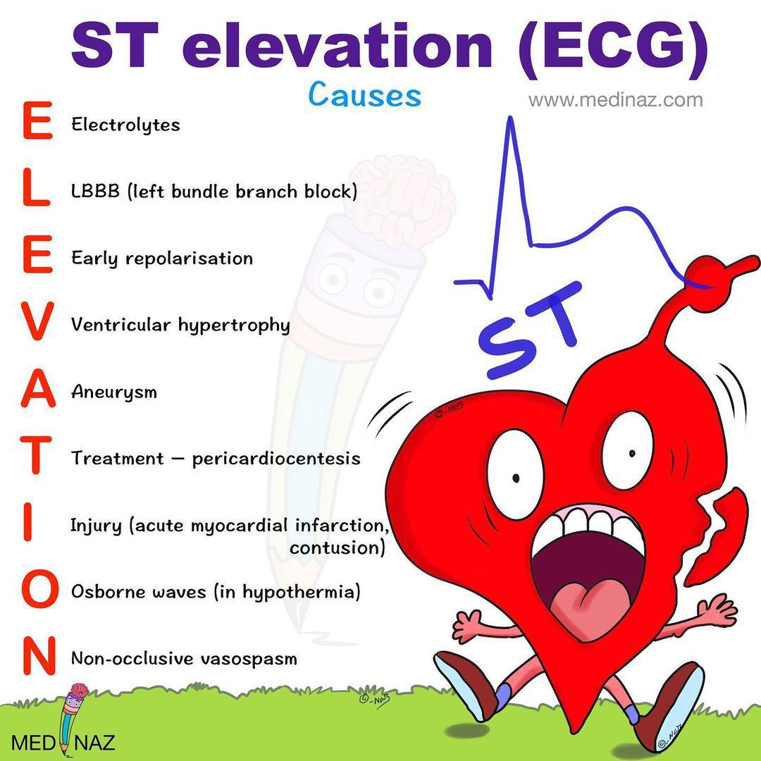 Causes of ST Elevation