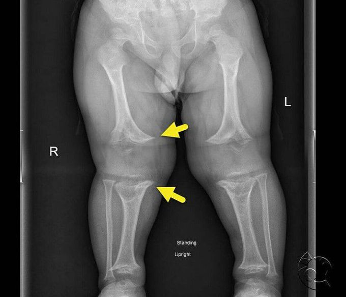 Achondroplasia