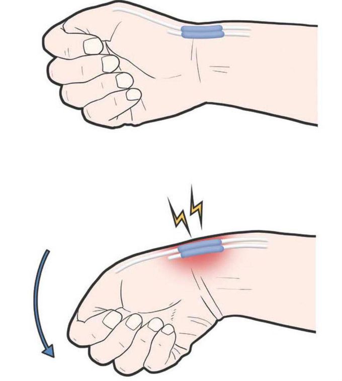 Name of test ? 

Which tendons is affected?