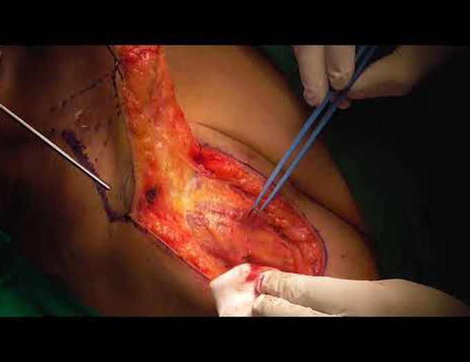 supraclavicular flap