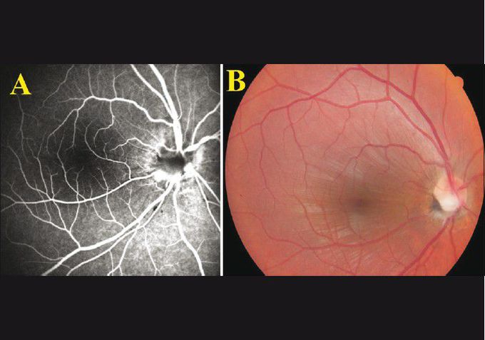 (A) Fluorescein angiography and (B) fundus photo revealing choroidal folds and partial optic nerve avulsion on the 20th day after the trauma
