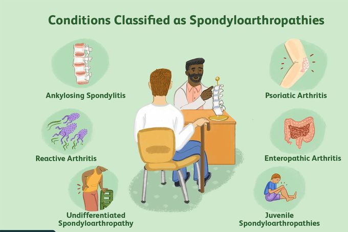 Spondyloarthropathy