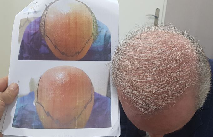 Hairtransplant  from beard to scalp