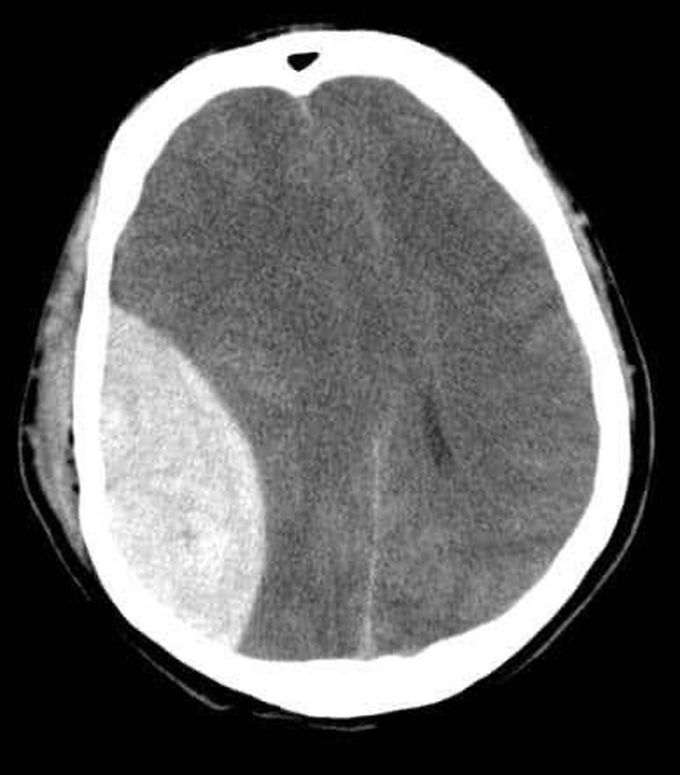 Extradural hematoma