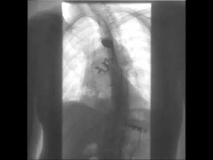 Bronchoesophageal Fistulam