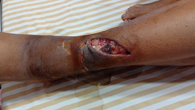 Non-healing diabetic foot injury