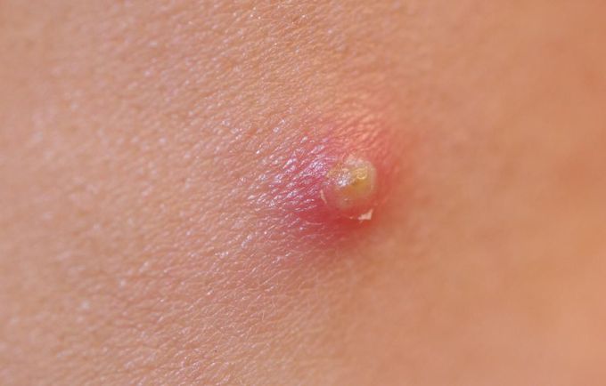 Pustules pimples