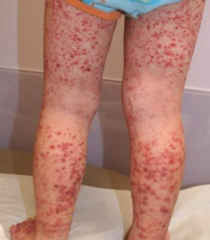 A 6years old boy presents  with joint pain,hematuria and blood in the stool following an episode of pharyngitis 2weeks ago. Examination reveals palpable red lesions on lower extremities as seen in fig ,This patient's disease is most similar to which of the following disease?                                                            1.Idiopathic thrombocytopenic purpura
2.SLE
3.Berger's disease
4.Osler Weber rendu syndrome