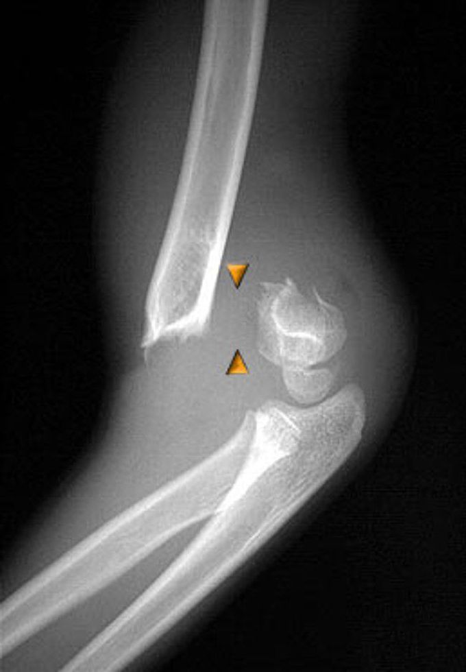 Fracture