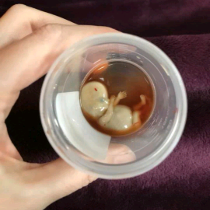 Miscarriage