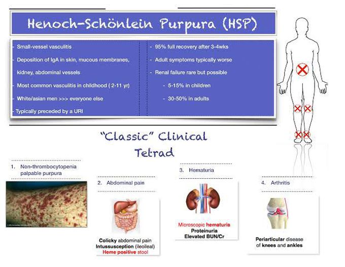 Henoch-Schonlein Purpura