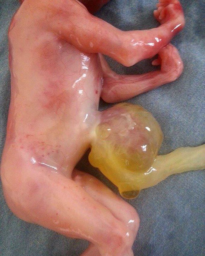 Omphalocele